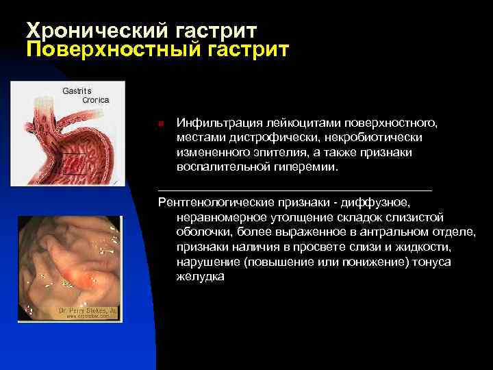 Хронический гастрит Поверхностный гастрит Инфильтрация лейкоцитами поверхностного, местами дистрофически, некробиотически измененного эпителия, а также