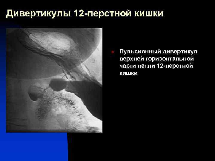 Дивертикулы 12 -перстной кишки n Пульсионный дивертикул верхней горизонтальной части петли 12 -перстной кишки