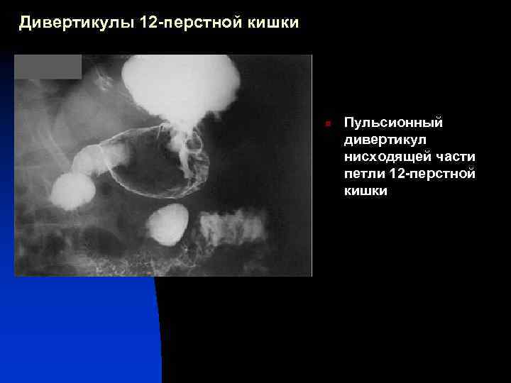 Мобилизация 12 перстной кишки по кохеру схема