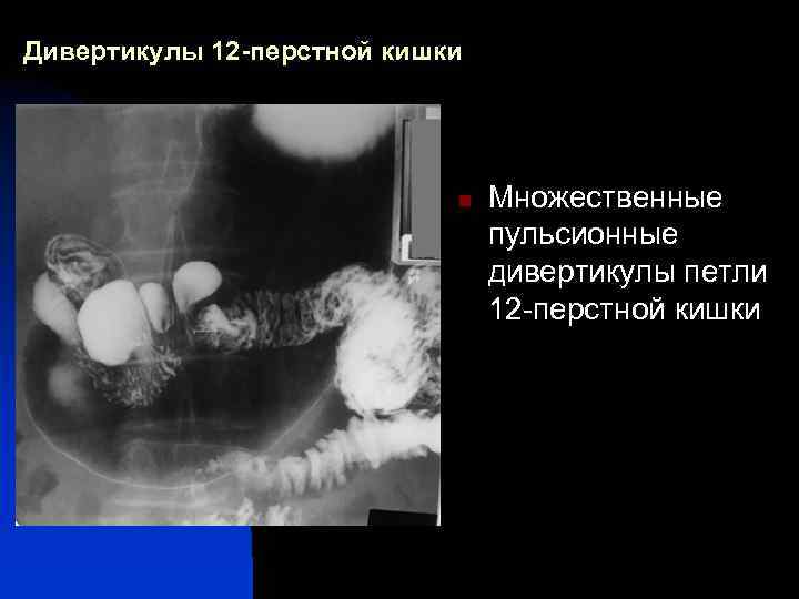 Дивертикулы 12 -перстной кишки n Множественные пульсионные дивертикулы петли 12 -перстной кишки 