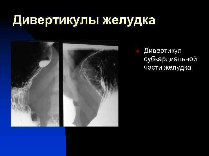 Дивертикулы желудка n Дивертикул субкардиальной части желудка 