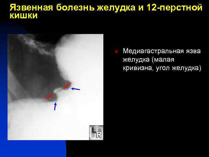 Язвенная болезнь желудка и 12 -перстной кишки n Медиагастральная язва желудка (малая кривизна, угол