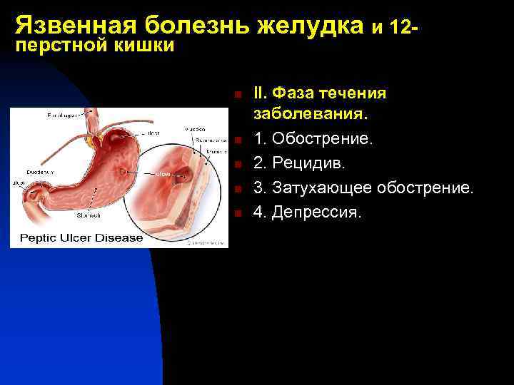 Язвенная болезнь желудка и 12 перстной кишки n n n II. Фаза течения заболевания.