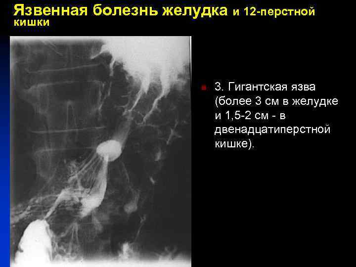 Язвенная болезнь желудка и 12 -перстной кишки n 3. Гигантская язва (более 3 см