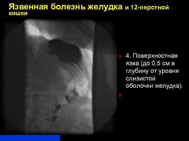 Язвенная болезнь желудка и 12 -перстной кишки n n 4. Поверхностная язва (до 0,