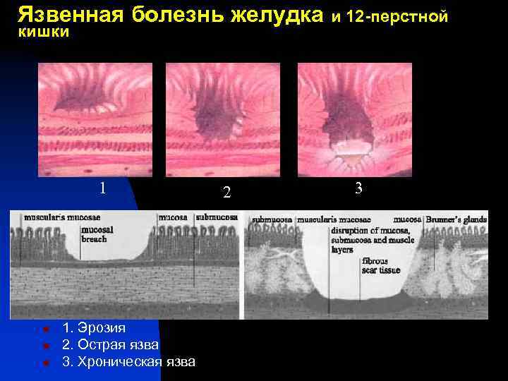 Язвенная болезнь желудка и 12 -перстной кишки 1 n n n 1. Эрозия 2.