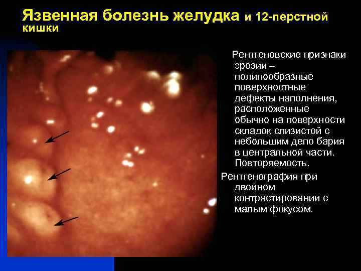 Язвенная болезнь 12 перстной кишки картинки