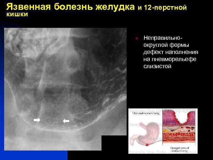 Язвенная болезнь желудка и 12 -перстной кишки n Неправильноокруглой формы дефект наполнения на пневморельефе