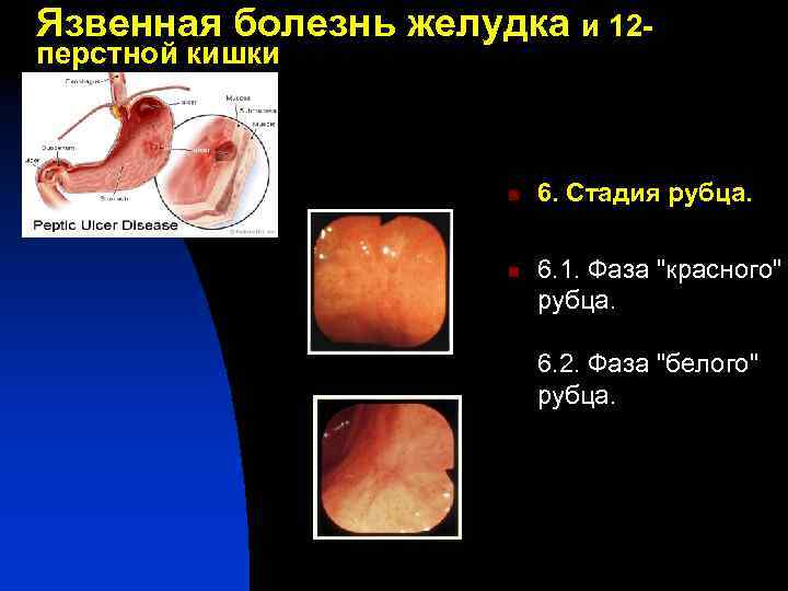 Язвенная болезнь 12 перстной кишки картинки
