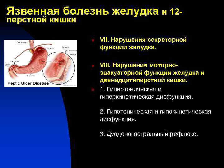 Язвенная болезнь желудка и 12 перстной кишки n n n VII. Нарушения секреторной функции