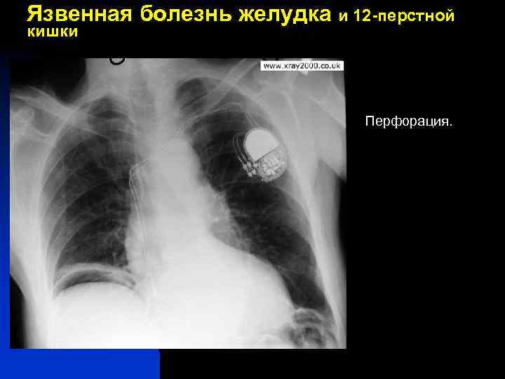 Язвенная болезнь желудка и 12 -перстной кишки Перфорация. 