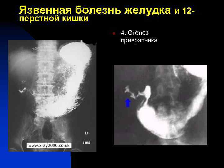 Язвенная болезнь желудка и 12 перстной кишки n 4. Стеноз привратника 