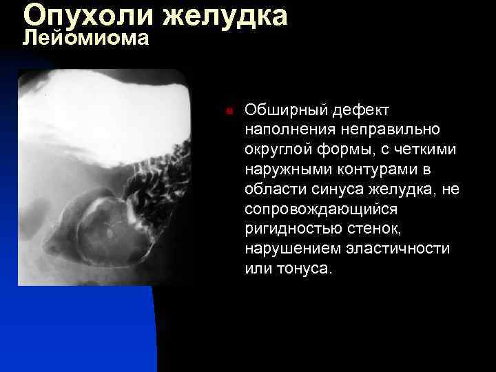 Опухоли желудка Лейомиома n Обширный дефект наполнения неправильно округлой формы, с четкими наружными контурами