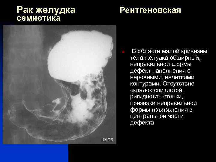 Рак антрального отдела. Рентгенограмма 12 перстной кишки. Опухоль желудка на рентгене признаки. Злокачественная опухоль желудка рентген. Экзофитная опухоль желудка рентген.
