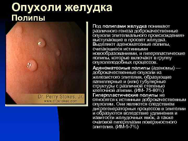 Опухоли желудка Полипы n n Под полипами желудка понимают различного генеза доброкачественные опухоли эпителиального