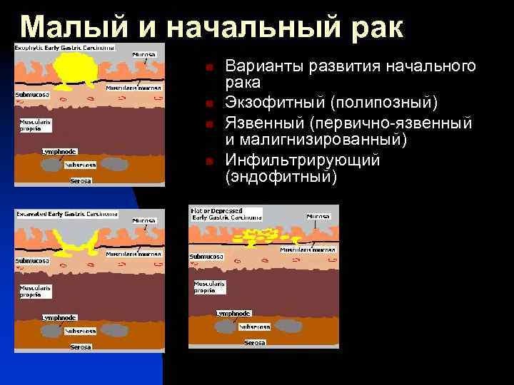 Малый и начальный рак n n Варианты развития начального рака Экзофитный (полипозный) Язвенный (первично-язвенный