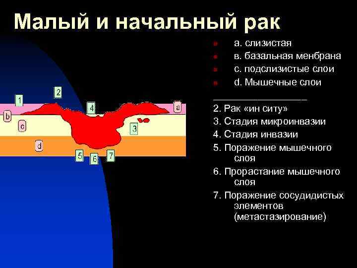 Малый и начальный рак а. слизистая n в. базальная менбрана n с. подслизистые слои