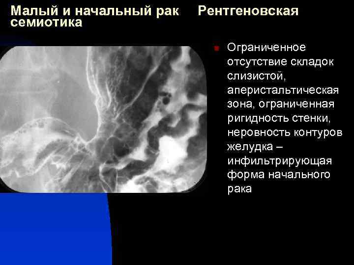 Малый и начальный рак семиотика Рентгеновская n Ограниченное отсутствие складок слизистой, аперистальтическая зона, ограниченная