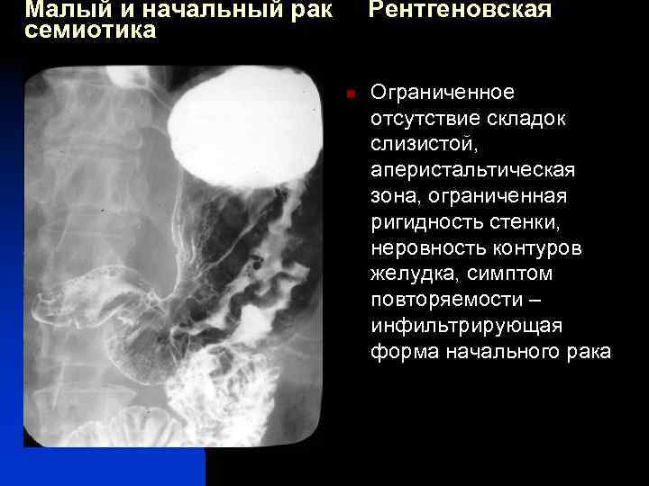 Малый и начальный рак семиотика Рентгеновская n Ограниченное отсутствие складок слизистой, аперистальтическая зона, ограниченная
