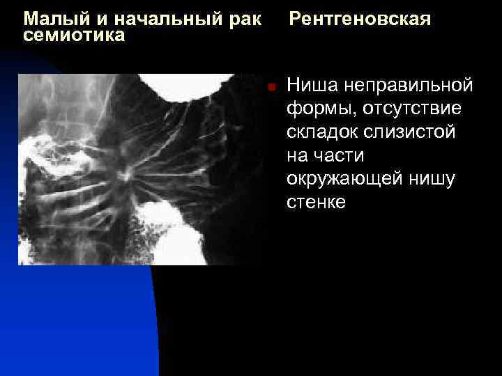 Малый и начальный рак семиотика Рентгеновская n Ниша неправильной формы, отсутствие складок слизистой на