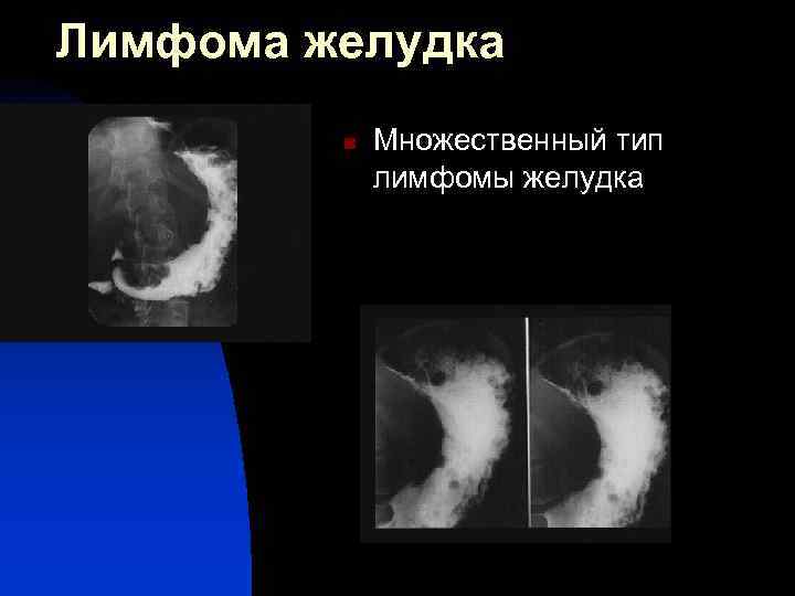 Лимфома желудка n Множественный тип лимфомы желудка 