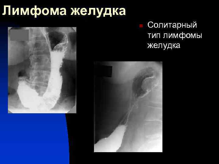 Лимфома желудка n Солитарный тип лимфомы желудка 