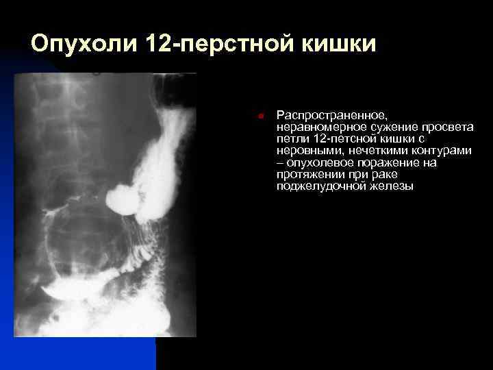 Контуры поджелудочной железы неровные нечеткие. Стеноз сужение 12 пёрстной кишки. Опухоль 12 перстной кишки на рентгене. Опухоль в 12 перстной кишки УЗИ. Рпузаль в 12 перстная кишка.