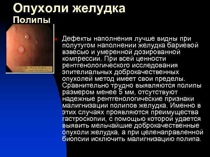 Опухоли желудка Полипы n Дефекты наполнения лучше видны при полутугом наполнении желудка бариевой взвесью