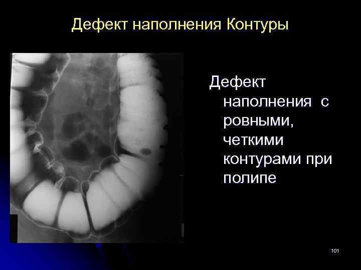 С ровными четкими контурами. Симптом дефекта наполнения. Дефект наполнения кишки. Краевой дефект наполнения.