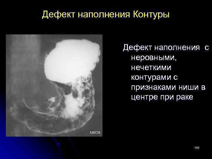 Контуры поджелудочной железы неровные нечеткие. Краевой дефект наполнения желудка рентген. Дефект наполнения рентген. Дефект наполнения кишки.