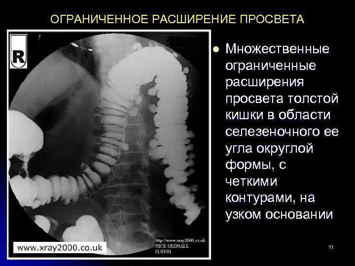 ОГРАНИЧЕННОЕ РАСШИРЕНИЕ ПРОСВЕТА l Множественные ограниченные расширения просвета толстой кишки в области селезеночного ее