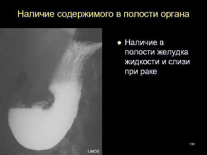 Наличие содержимого в полости органа l Наличие в полости желудка жидкости и слизи при