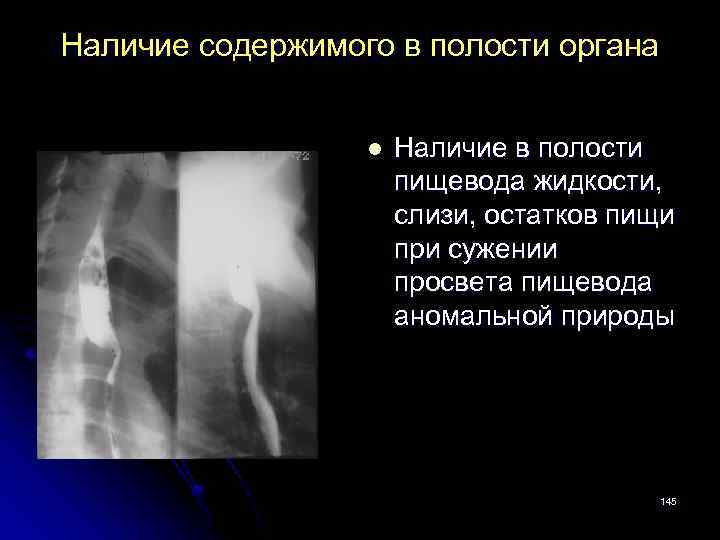 Наличие содержимого в полости органа l Наличие в полости пищевода жидкости, слизи, остатков пищи