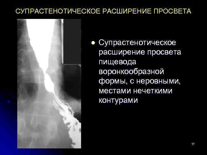 Расширение пищевода. Супрастенотическое расширение пищевода. Супрастенотическое расширение пищевода рентген. Супрастенотическое сужение пищевода. Веретенообразное расширение пищевода.