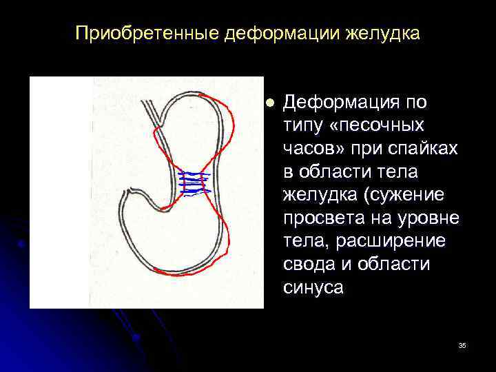 Приобретенные деформации желудка l Деформация по типу «песочных часов» при спайках в области тела