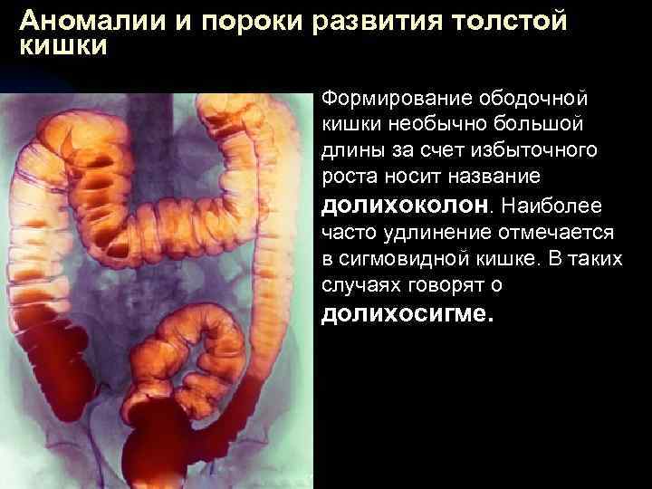 Аномалии и пороки развития толстой кишки n Формирование ободочной кишки необычно большой длины за