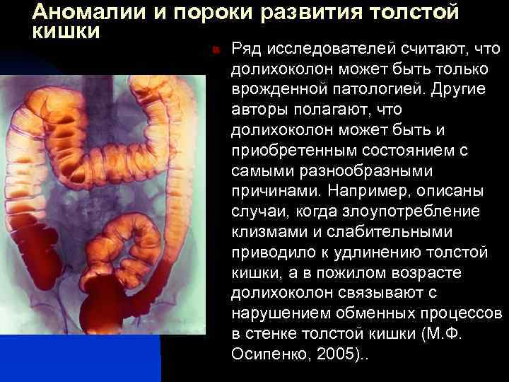 Аномалии и пороки развития толстой кишки n Ряд исследователей считают, что долихоколон может быть