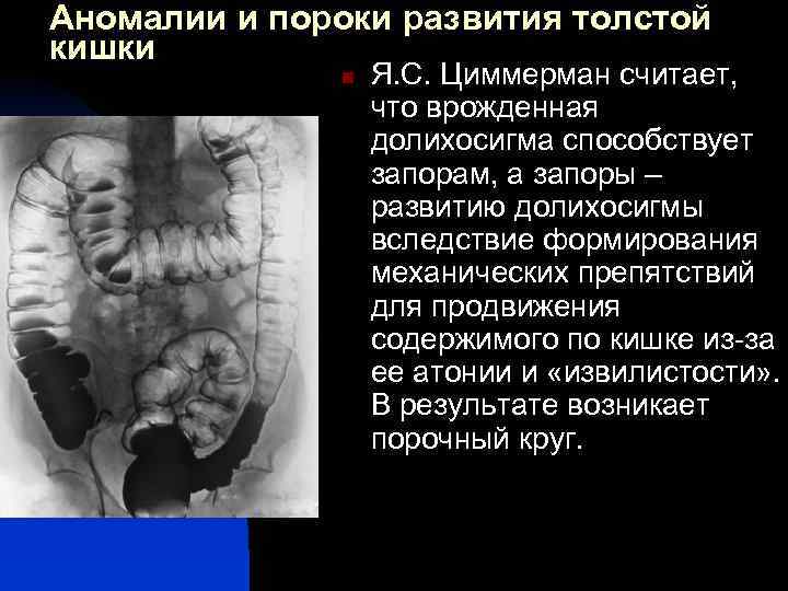 Аномалии и пороки развития толстой кишки n Я. С. Циммерман считает, что врожденная долихосигма