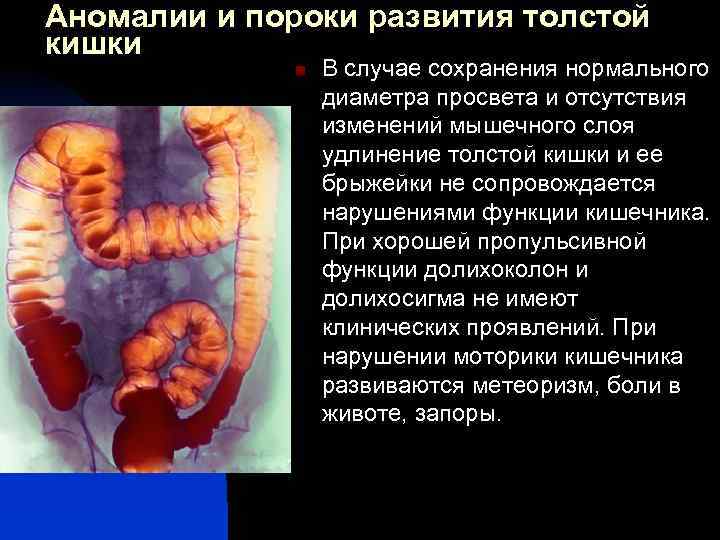Аномалии и пороки развития толстой кишки n В случае сохранения нормального диаметра просвета и