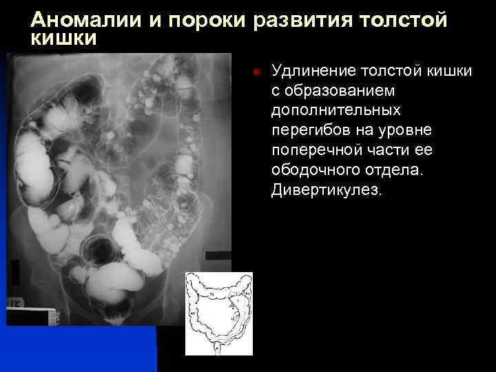 Аномалии и пороки развития толстой кишки n n Удлинение толстой кишки с образованием дополнительных