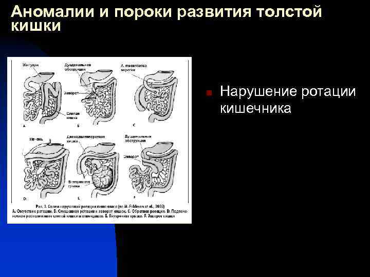 Аномалии и пороки развития толстой кишки n Нарушение ротации кишечника 