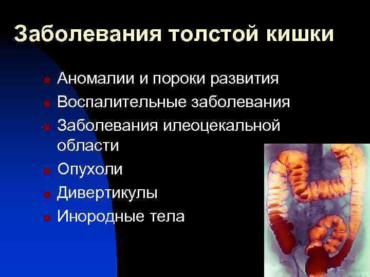 Заболевания толстой кишки n n n Аномалии и пороки развития Воспалительные заболевания Заболевания илеоцекальной