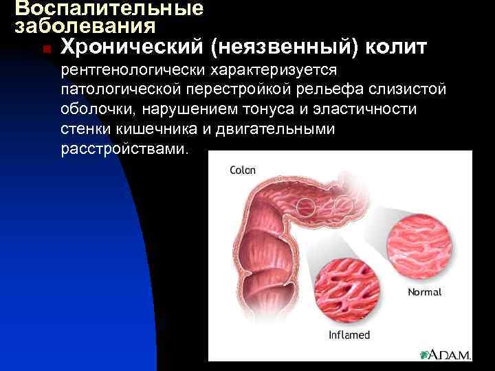 Воспалительные заболевания n Хронический (неязвенный) колит рентгенологически характеризуется патологической перестройкой рельефа слизистой оболочки, нарушением