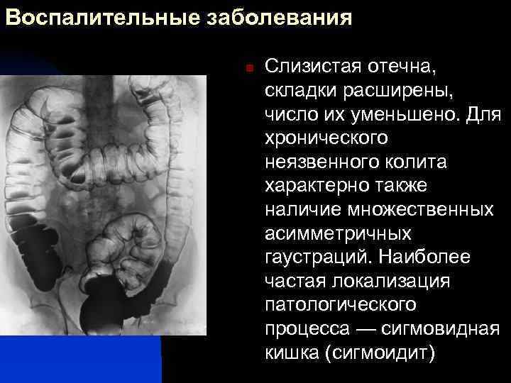 Воспалительные заболевания n Слизистая отечна, складки расширены, число их уменьшено. Для хронического неязвенного колита