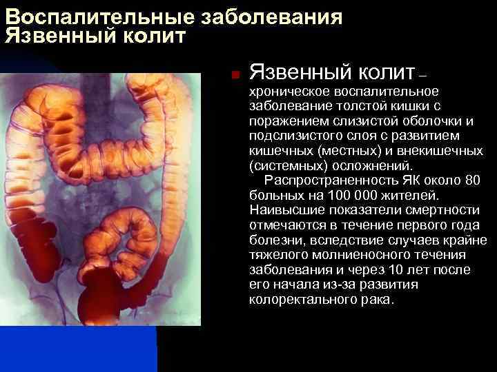 Воспалительные заболевания Язвенный колит n Язвенный колит – хроническое воспалительное заболевание толстой кишки с