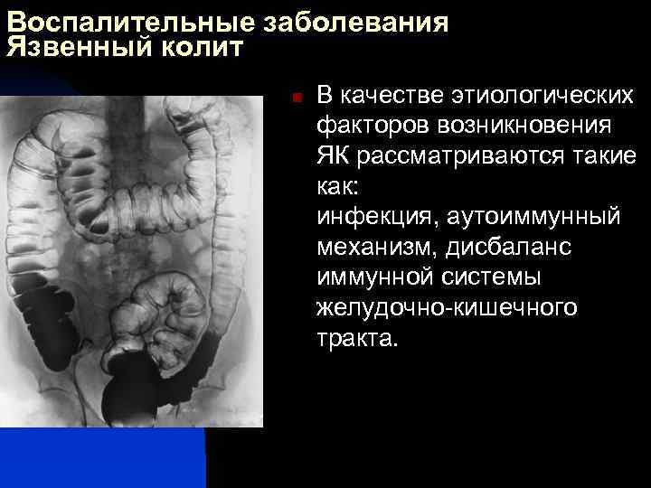Воспалительные заболевания Язвенный колит n В качестве этиологических факторов возникновения ЯК рассматриваются такие как: