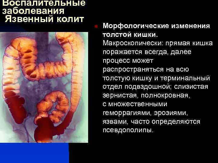 Схема изменений толстой кишки при болезни гиршпрунга