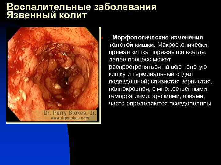 Воспалительные заболевания Язвенный колит n . Морфологические изменения толстой кишки. Макроскопически: прямая кишка поражается
