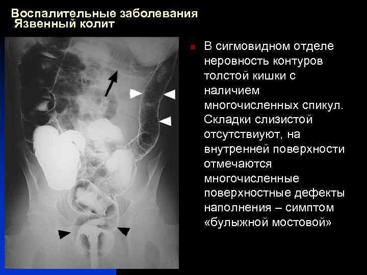 Воспалительные заболевания Язвенный колит n В сигмовидном отделе неровность контуров толстой кишки с наличием