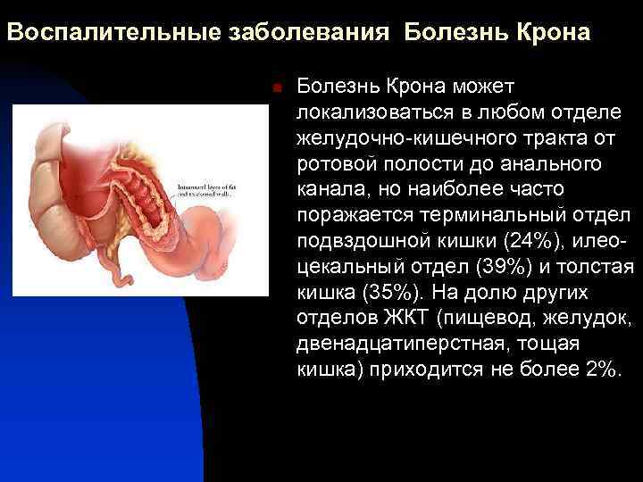 Воспалительные заболевания Болезнь Крона n Болезнь Крона может локализоваться в любом отделе желудочно-кишечного тракта